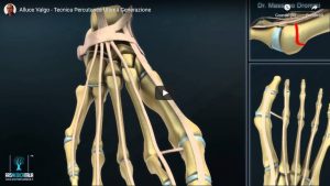 video_tecnicapercutanea_ultimagenerazione3D Tecnica Percutanea di Ultima Generazione - descrizione video in 3D Dr Massimo Drommi
